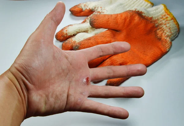 Blister on hand because do not wear safety glove — Stock Photo, Image