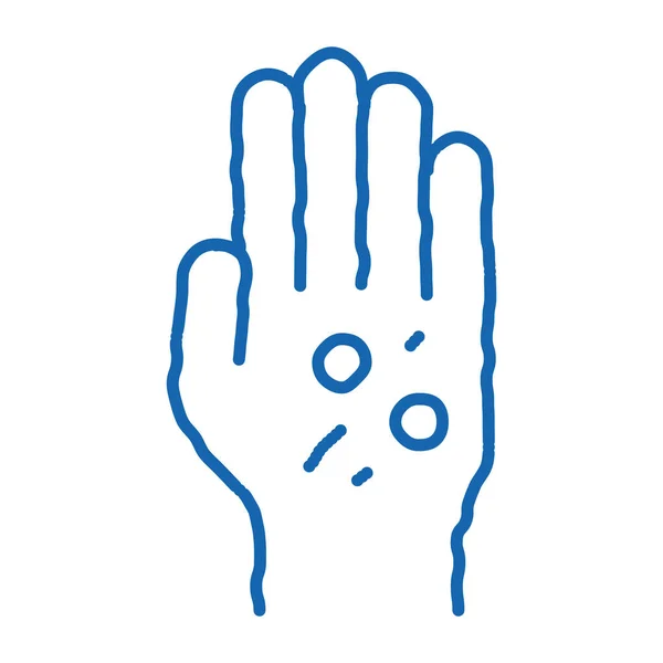 Dermatitis kiütés a kézen firka ikon kézzel rajzolt illusztráció — Stock Vector