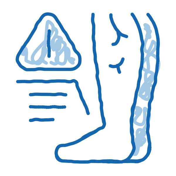 Pies fríos debido a la aterosclerosis, problema de salud garabato icono dibujado a mano ilustración — Archivo Imágenes Vectoriales