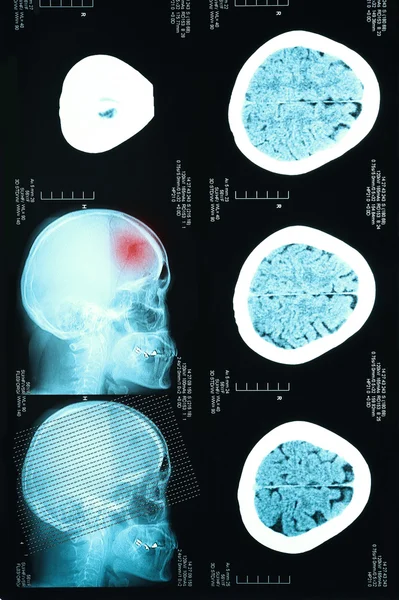 Obrazy z tomografii komputerowej mózgu — Zdjęcie stockowe