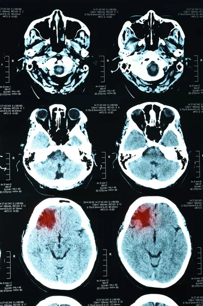 Obrázky z počítačové tomografie mozku — Stock fotografie