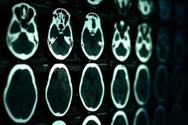 Bilgisayarlı Tomografi görüntüleri