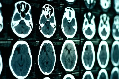 Bilgisayarlı Tomografi görüntüleri