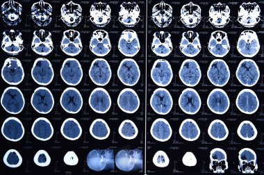 Beynin bilgisayarlı tomografisinden görüntüler
