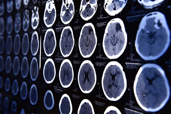 Beynin bilgisayarlı tomografisinden görüntüler — Stok fotoğraf