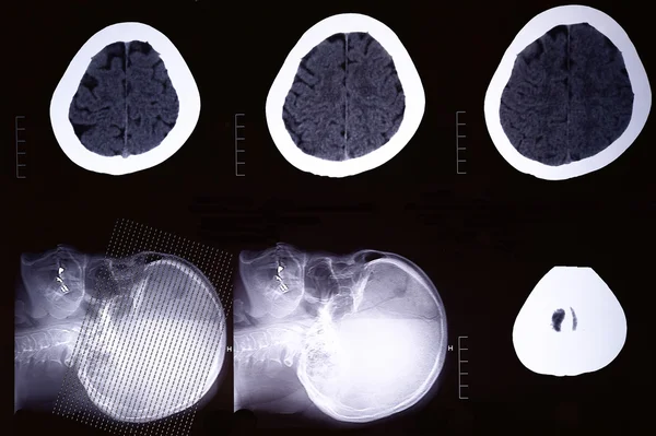 Изображения из компьютеризированной томографии мозга — стоковое фото