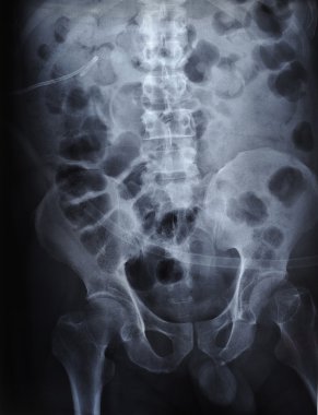 X ray film ureteric stent ile böbrek taşlarının