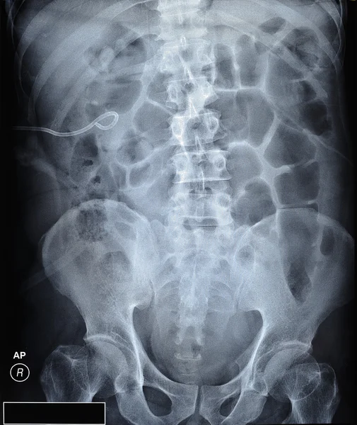 X ray film ureteric stent ile böbrek taşlarının — Stok fotoğraf