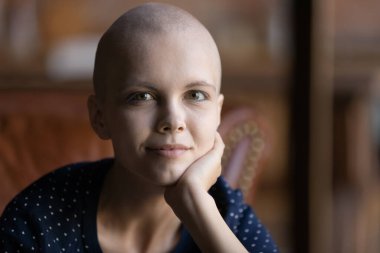 Fotoğraf makinesine bakan hasta, kılsız kadın portresi.