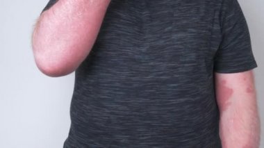 Adam ellerini çok kaşındıran sedef hastalığıyla kaplamış. Eklemleri ve eklemleri ağrıyormuş. Sedef hastalığı, egzama ve diğer kuru deri hastalıkları.