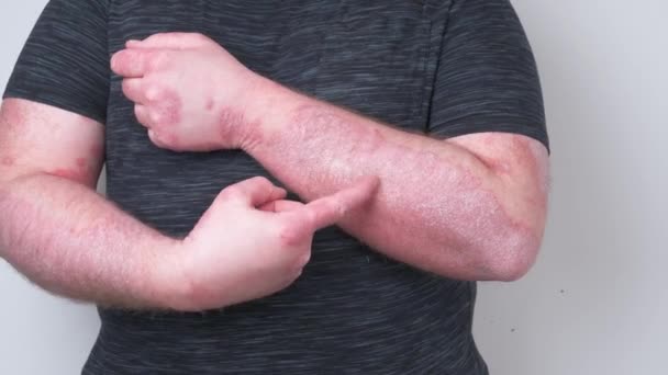 Facet Drapie Się Rękach Pokrytych Łuszczycą Która Bardzo Swędzi Pojęcie — Wideo stockowe