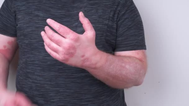 男は非常にかゆみと彼の関節が痛い乾癬 湿疹や乾燥肌の他の病気の概念に覆われた彼の手を傷 — ストック動画