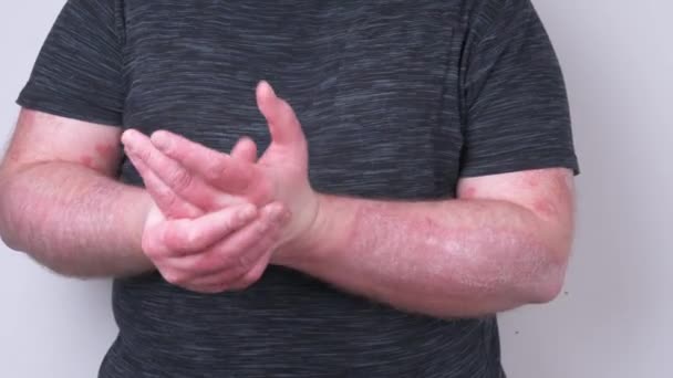 Facet Drapie Się Rękach Pokrytych Łuszczycą Która Bardzo Swędzi Bolą — Wideo stockowe