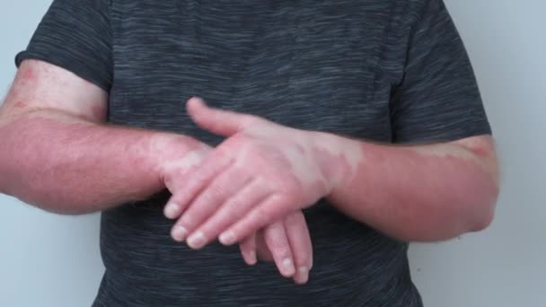 Facet Rozmazuje Ręce Maścią Ręce Pokryte Łuszczycą Która Bardzo Swędzi — Wideo stockowe