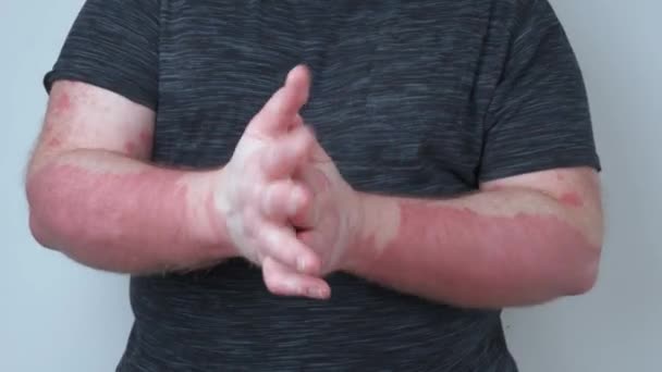 남자가 기름으로 찌르고 건선으로 있는데 이것은 가려운 피부의 질병의 개념입니다 — 비디오