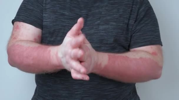 Hombre Mancha Sus Manos Con Ungüento Sus Manos Cubiertas Psoriasis — Vídeo de stock