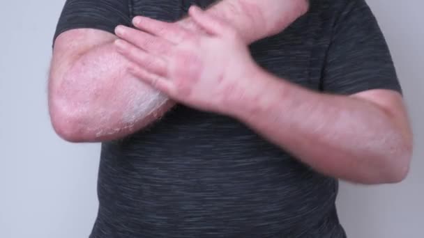 남자가 기름으로 찌르고 건선으로 있는데 이것은 가려운 피부의 질병의 개념입니다 — 비디오