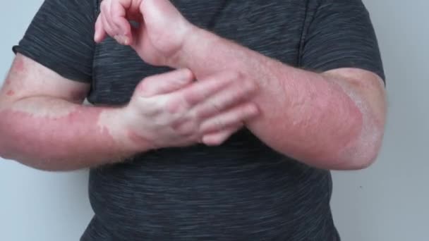 Facet Rozmazuje Ręce Maścią Ręce Pokryte Łuszczycą Która Bardzo Swędzi — Wideo stockowe