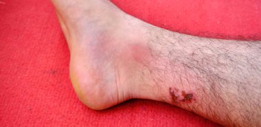 Bir adamın bacağında ve topuğunda büyük bir yara.