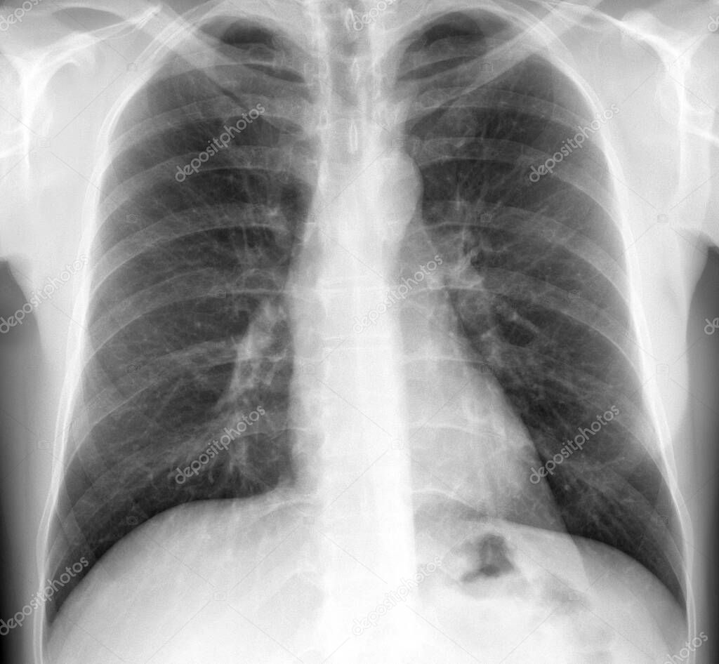 X-Ray Image Of Human Chest