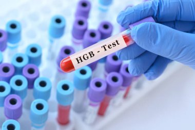 Hemoglobin (HGB) testi için kan örneği tüpü tutan bir doktor. Kırmızı kan hücreleri ve oksijen taşımacılığının laboratuvar teşhisi, anemi tespiti, genel kan değerlendirmesi, metin için boşluk