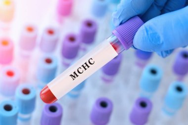 MCHC testi ile kan örneği tüpü tutan doktor, anemi teşhisi için korusküler hemoglobin konsantrasyon analizi, kırmızı kan hücresi kalite değerlendirmesi ve hemoglobin doygunluk değerlendirmesi, kopyalama alanı
