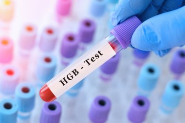 Hemoglobin (HGB) testi için kan örneği tüpü tutan bir doktor. Kırmızı kan hücreleri ve oksijen taşımacılığının laboratuvar teşhisi, anemi tespiti, genel kan değerlendirmesi, metin için boşluk