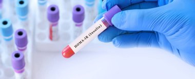 Modern Laboratuvarda HOMA Kızılötesi Kan Test Tüpü, İnsülin Direnç Analizi, Diyabet Risk Değerlendirmesi, Metabolik Sağlık Teşhisi ve Tıbbi Araştırma Konsepti