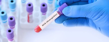 Hemoglobin (HGB) testi için kan örneği tüpü tutan bir doktor. Kırmızı kan hücreleri ve oksijen taşımacılığının laboratuvar teşhisi, anemi tespiti, genel kan değerlendirmesi, metin için boşluk