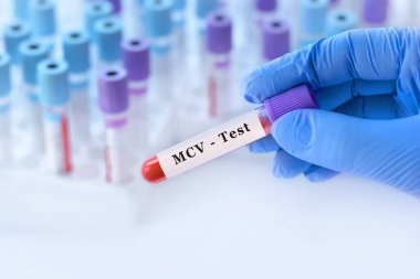 MCV testli kan örneği tüpü tutan doktor, anemi, kan hastalıkları teşhisi ve kan sayımı yorumu için kırmızı kan hücresinin boyutunu açıklayan ortalama korusküler hacim analizi.