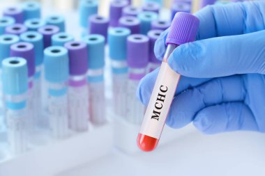 MCH testi ile kan örneği tüpü tutan doktor, anemi teşhisi için korusküler hemoglobin analizi, hemoglobin konsantrasyonu değerlendirmesi ve kırmızı kan hücresi sağlık değerlendirmesi, kopyalama alanı