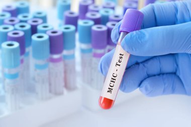 MCHC testi ile kan örneği tüpü tutan doktor, anemi teşhisi için korusküler hemoglobin konsantrasyon analizi, kırmızı kan hücresi kalite değerlendirmesi ve hemoglobin doygunluk değerlendirmesi, kopyalama alanı