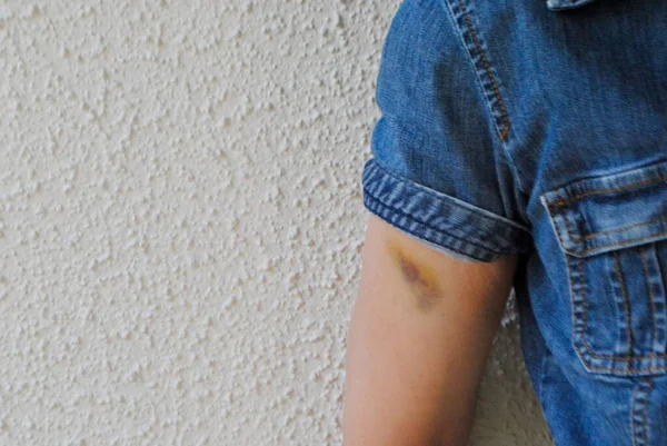 Moretones morados en el brazo de una mujer. El hematoma es un tipo de hematoma de tejido que causa una decoloración visible. Podría ser por inyección o accidentalmente golpear algo. hemorragia localizada. —  Fotos de Stock