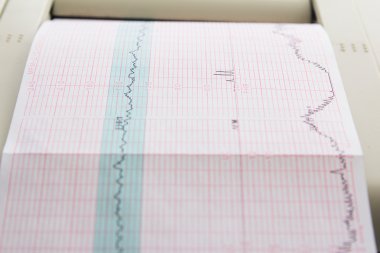 Electrocardiograph emek koğuşta gelen kardiyogram rapor baskı