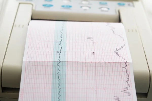 Nyomtatás cardiogram jelentés jön ki a munkaügyi ward Electrocardiograph — Stock Fotó