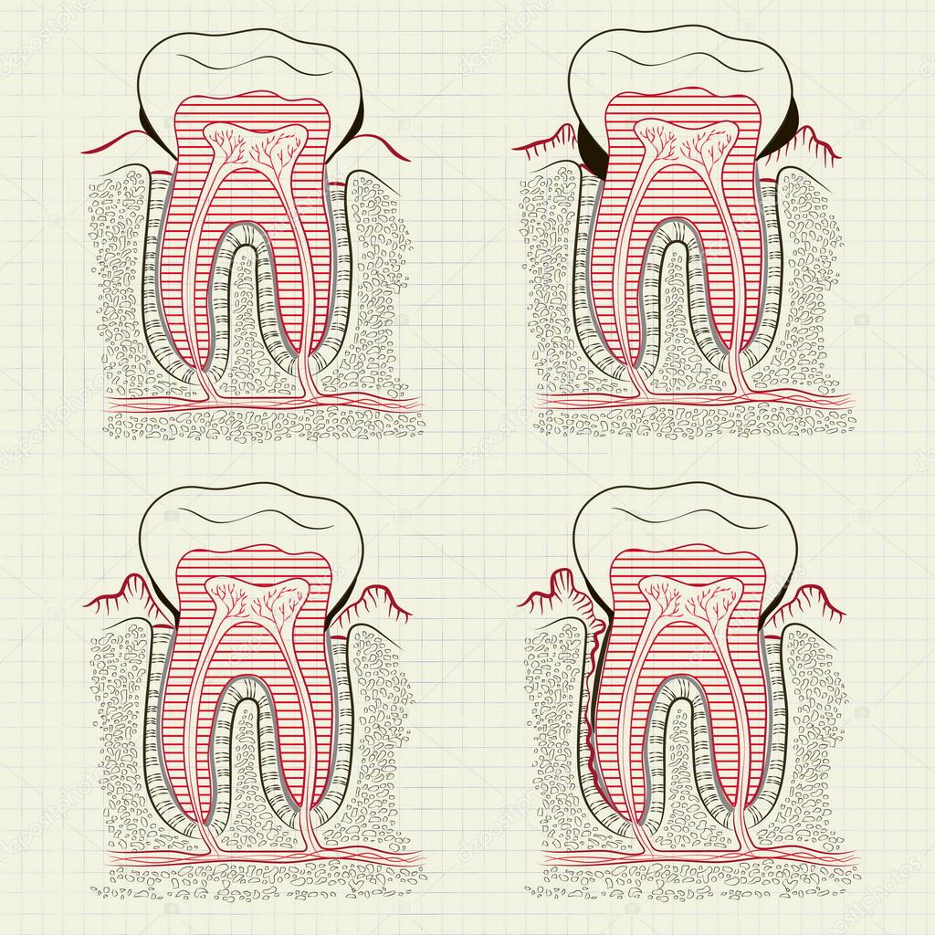 inflammation of the gums