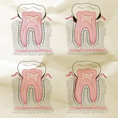 Dişeti hastalığı