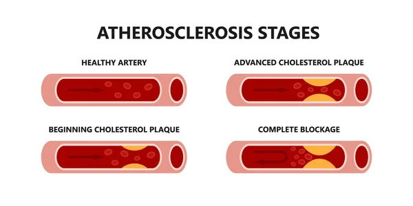 Atherosclerosis stages. Healthy and unhealthy arteries. Beginning cholesterol plaque, advanced cholesterol plaque, complete blockage. — Stock Vector