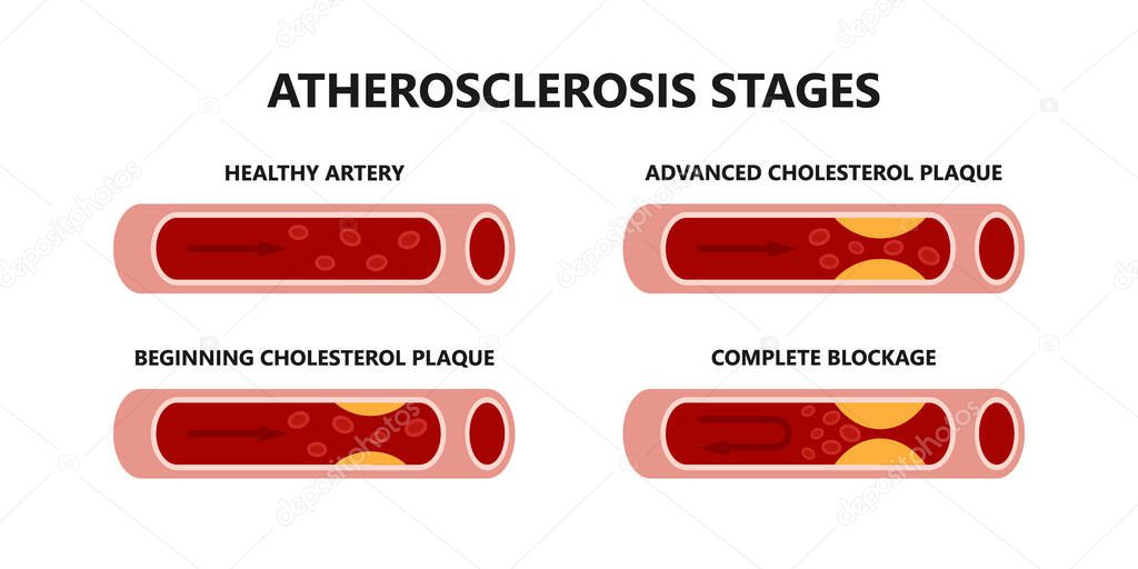 Atherosclerosis stages. Healthy and unhealthy arteries. Beginning cholesterol plaque, advanced cholesterol plaque, complete blockage.