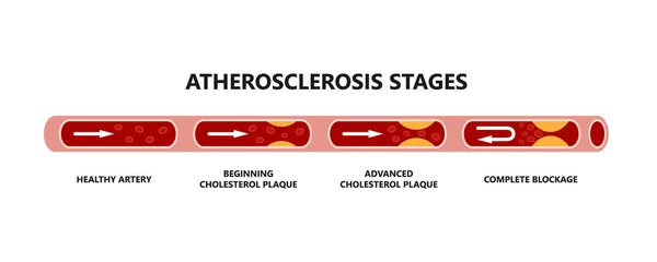 Etapas de aterosclerosis. Arteria saludable, inicio de placa de colesterol, placa avanzada de colesterol, bloqueo completo. — Vector de stock