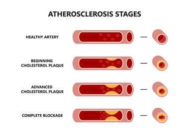 Ateroskleroz düzeni. Sağlıklı ve sağlıksız arterler. Kan damarlarında kolesterol plağı var..