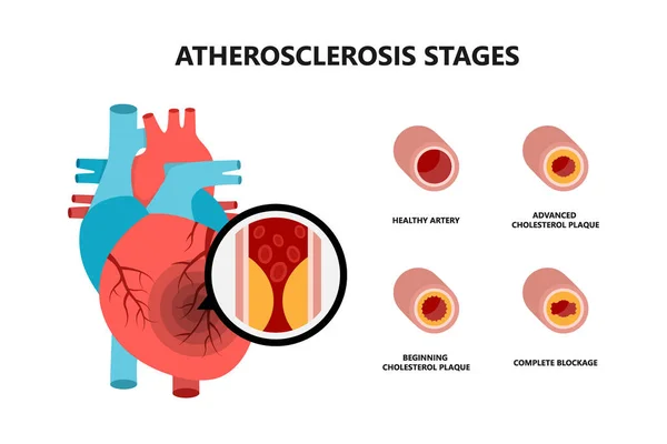 Aterosklerotik plaklı insan kalbi anatomisi. Kan damarlarında kolesterol plağı var.. — Stok Vektör