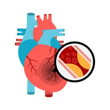 Kalp krizi geçiren insan kalbi anatomisi. Kan damarlarında damar tıkanıklığı var..