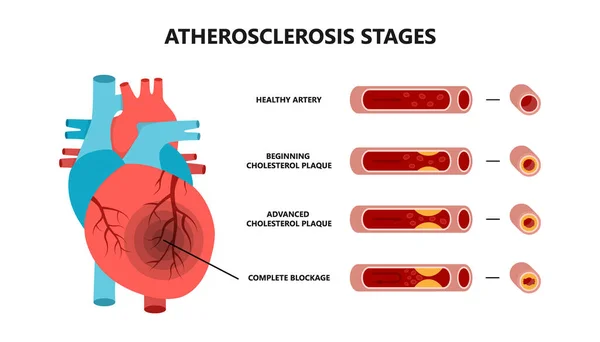 Kalp krizi ve ateroskleroz aşamaları. Sağlıklı atardamar, kolesterol plağı, gelişmiş kolesterol plağı, tam tıkanıklık.. — Stok Vektör