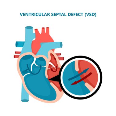 Ventriküler septal defekt VSD. İnsan kalp kası hastalıkları enine kesit. Kardiyoloji kavramı.