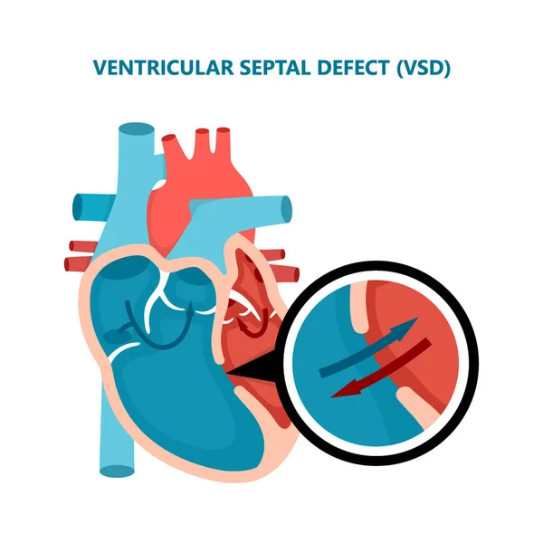 Kamrai szeptális hiba VSD. Emberi szívizombetegségek keresztmetszete. Kardiológiai fogalom. — Stock Vector