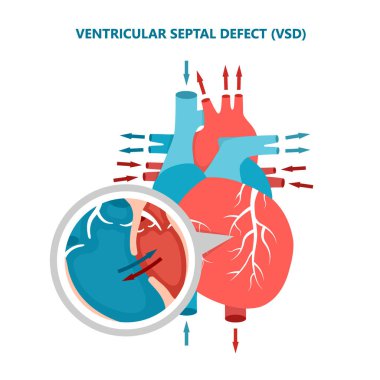 Ventriküler septal defekt kalp kan akışı olan VSD. İnsan kalp kası hastalıkları enine kesit.