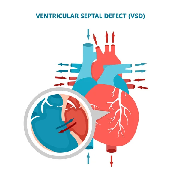 Defecto septal ventricular CIV con flujo sanguíneo cardíaco. Sección transversal de las enfermedades musculares del corazón humano. — Vector de stock