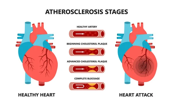 Kalp krizi ve ateroskleroz aşamaları. Sağlıklı ve sağlıksız arterler. Kan damarlarında kolesterol var.. — Stok Vektör