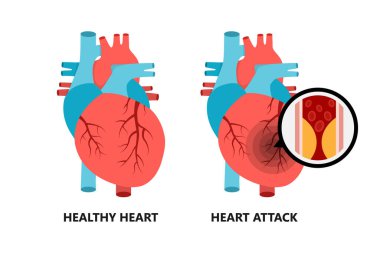 Healthy and unhealthy heart. Heart with atherosclerotic plaque. clipart